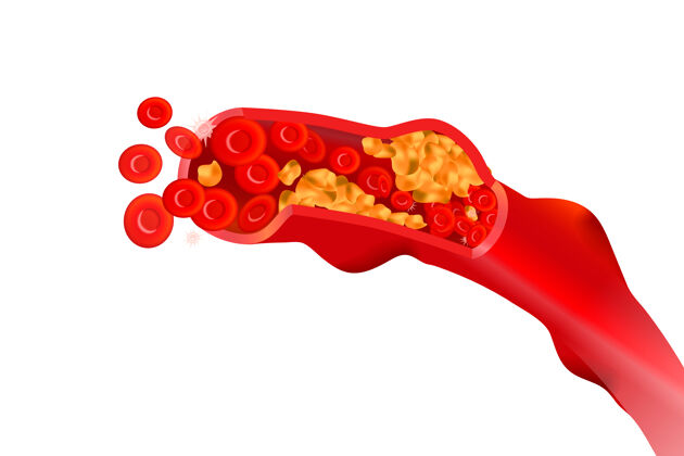 器官不健康的动脉有红细胞 高胆固醇 白细胞饮食细胞血管