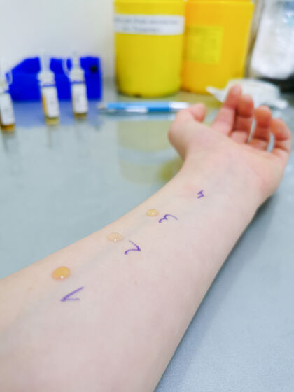 儿童孩子等待她或他的手臂皮肤点刺过敏测试的结果测量手过程