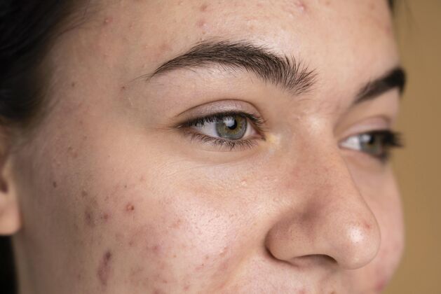 护理自信的年轻女性粉刺特写健康皮肤科肖像